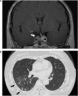 Fluconazole for Hypercortisolism in Cushing’s Disease: A Case Report and Literature Review